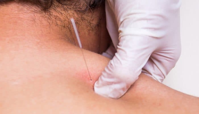 Myofascial Cupping Workshop Home