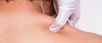 Dry Needling - Short Course - On-Campus Dry Needling - Short Course - On-Campus
