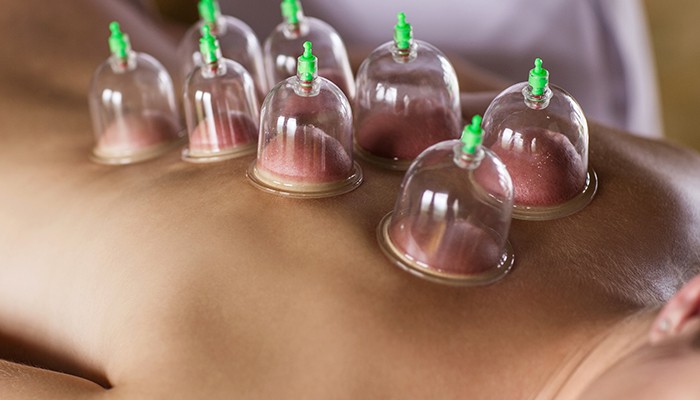 Myofascial Cupping Workshop Myofascial Cupping Workshop