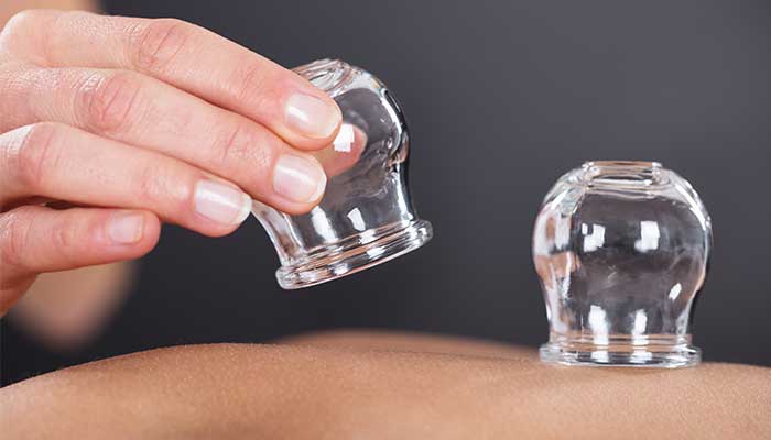What is Flame Cupping?