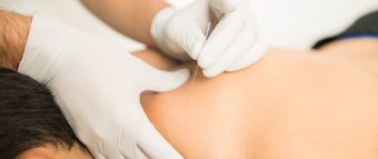 Dry Needling Dry Needling Course